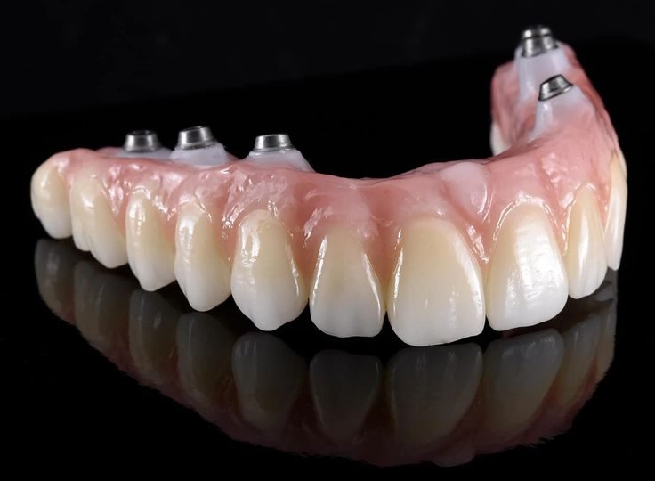 Prótesis sobre implantes